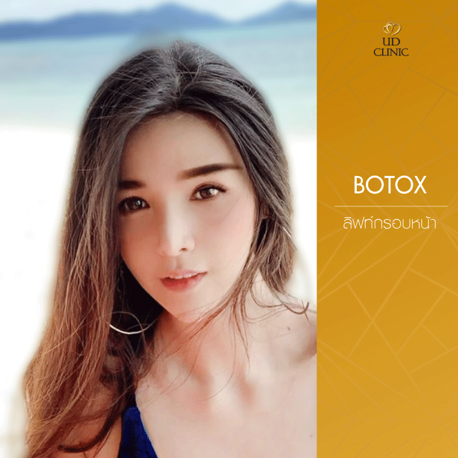 UD-Clinic-Review-Botox-1