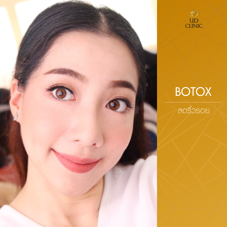UD-Clinic-Review-Botox-3