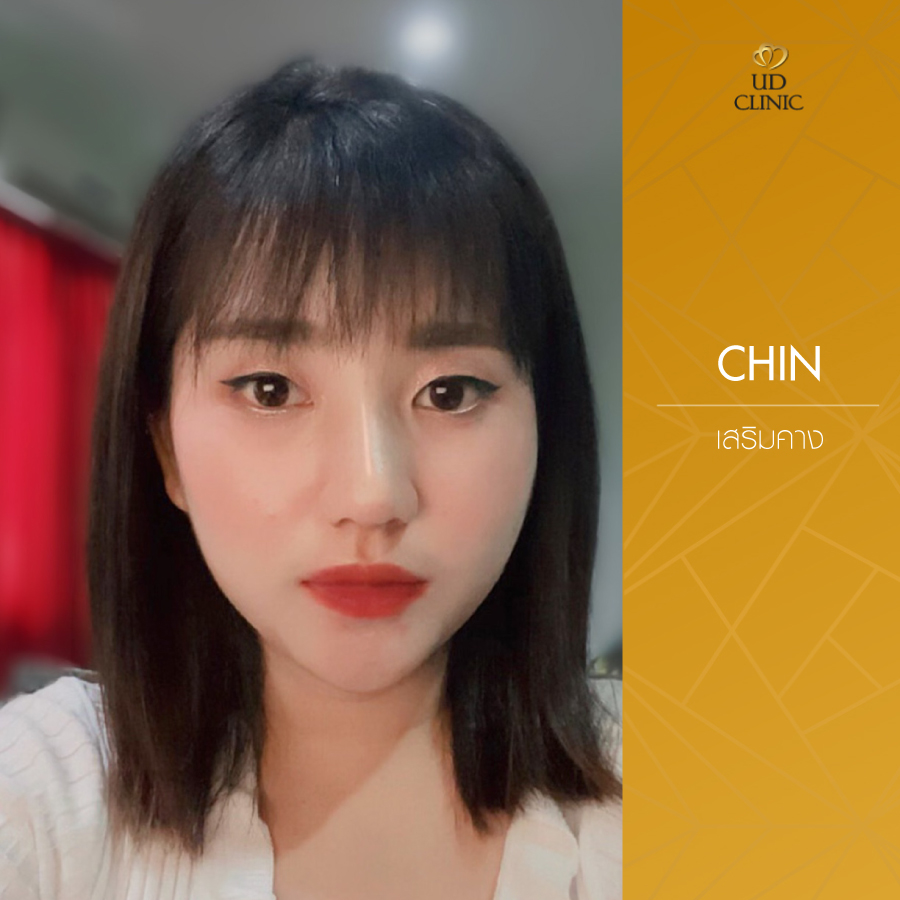UD-Clinic-Review-Chin-7