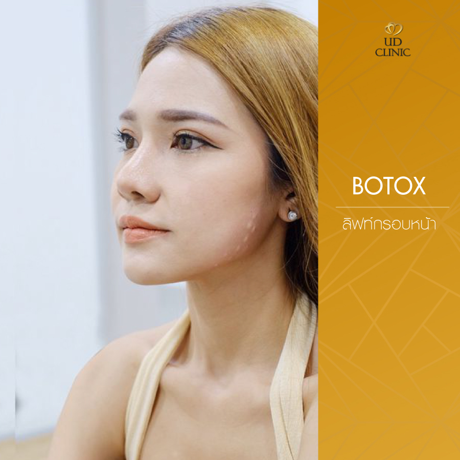 UD-Clinic-Review-Botox-8