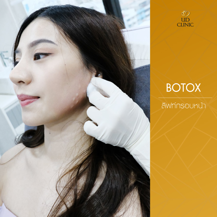 UD-Clinic-Review-Botox-9