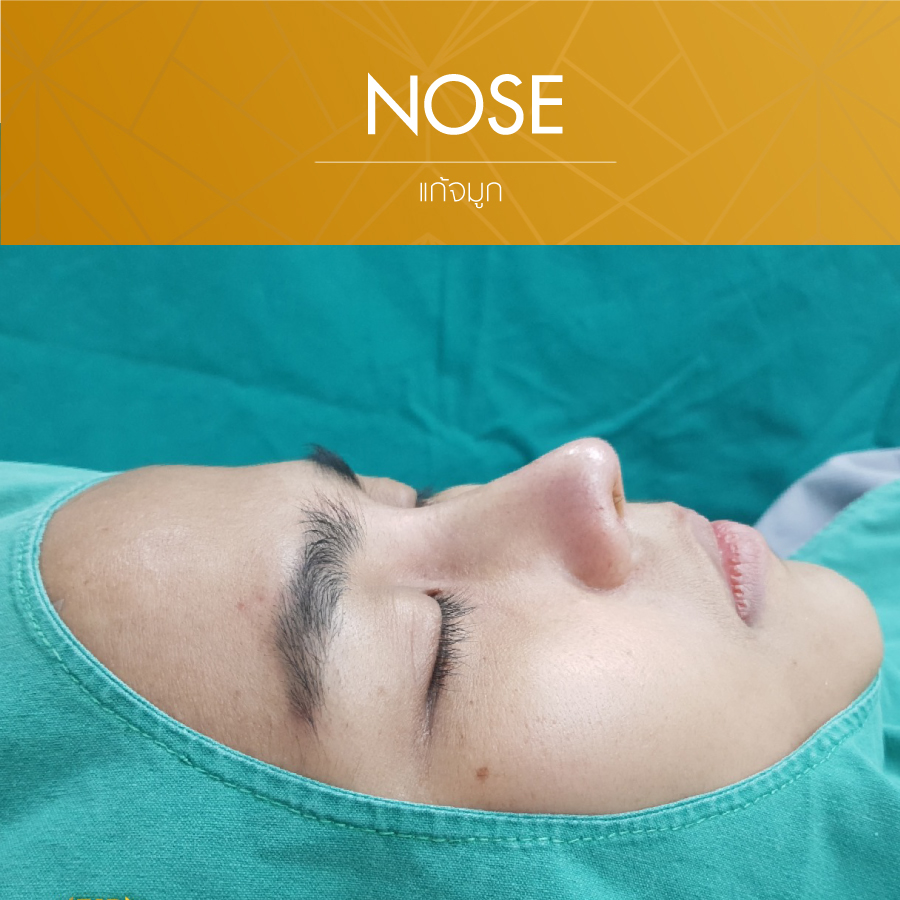 UD-Clinic-Review-Nose-22