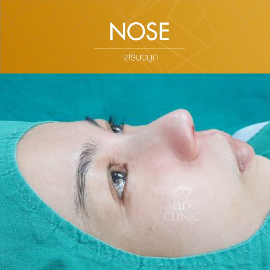 UD-Clinic-Review-Nose-25