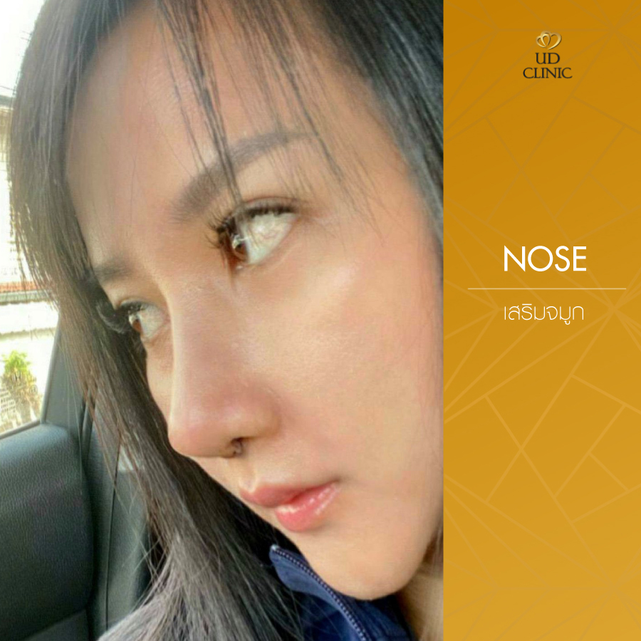 UD-Clinic-Review-Nose-26