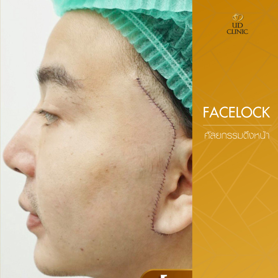 UD-Clinic-Review-facelock-9