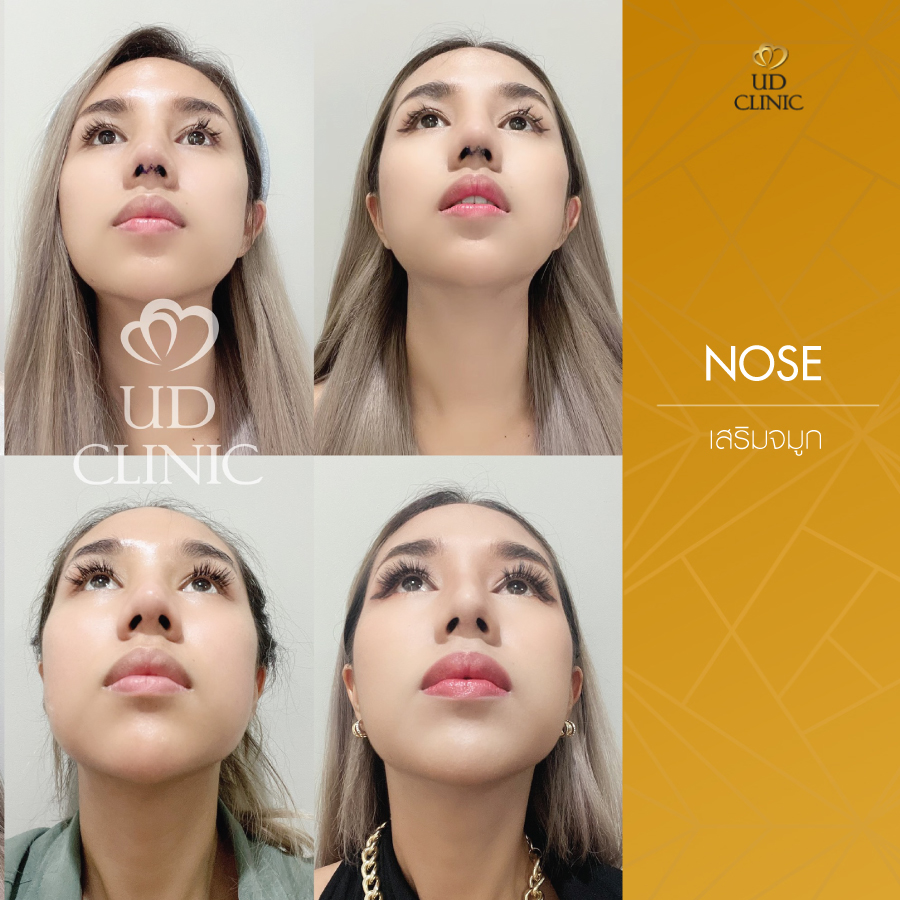 UD-Clinic-Review-Nose-28