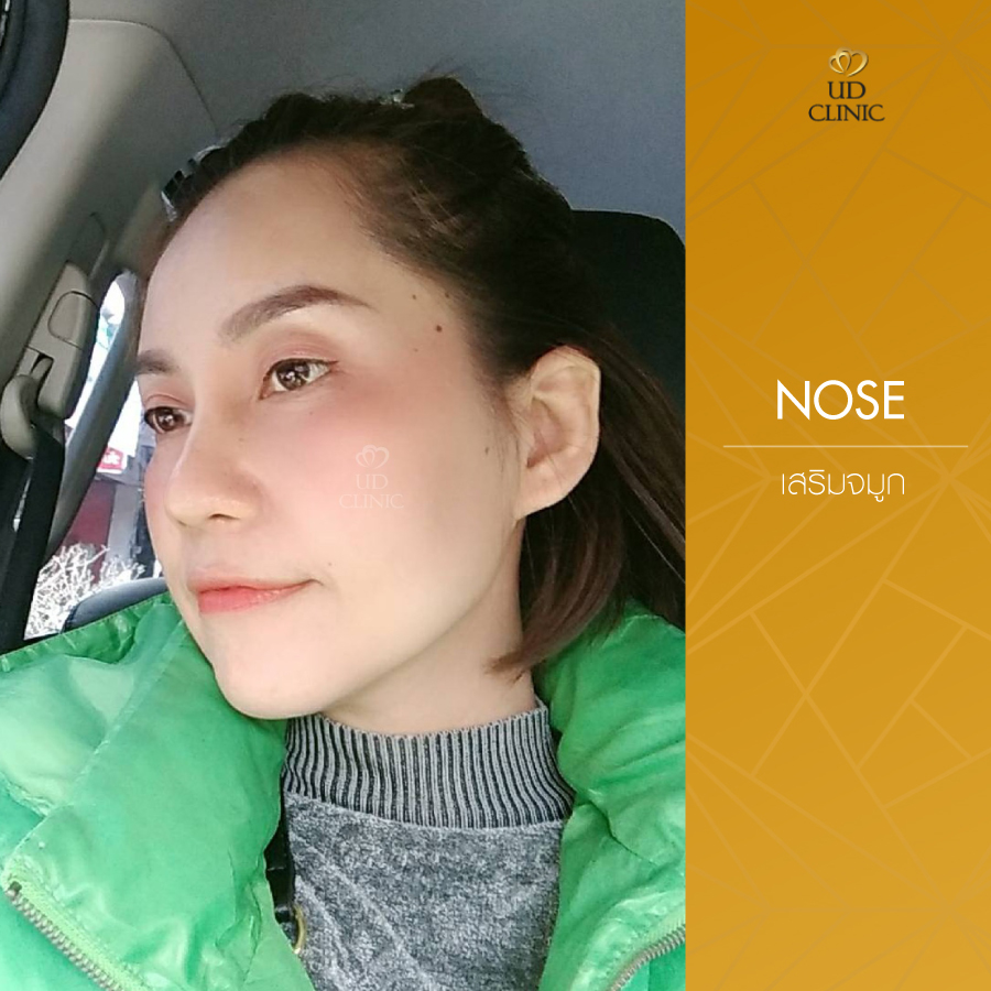UD-Clinic-Review-Nose-29
