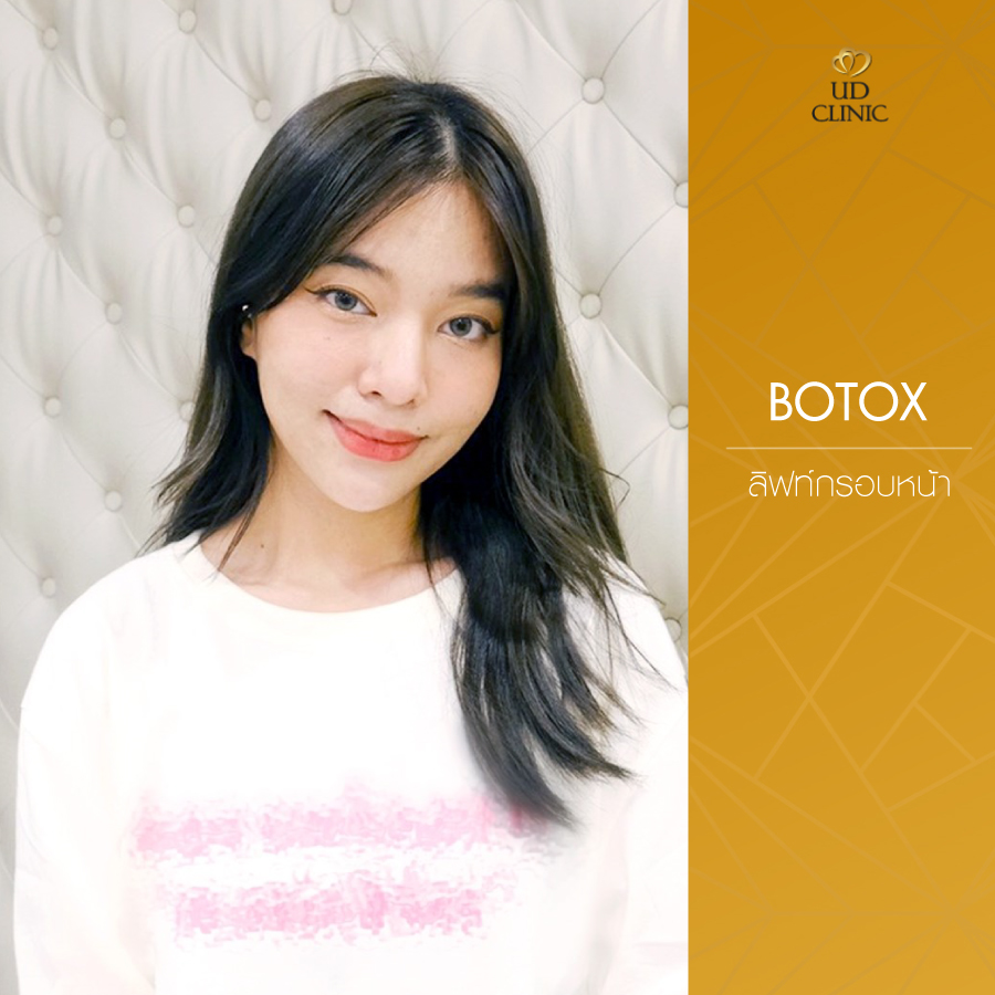 UD-Clinic-Review-Botox-13