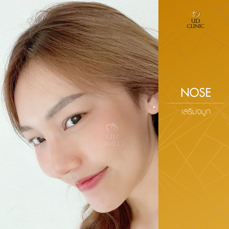 UD-Clinic-Review-Nose-34
