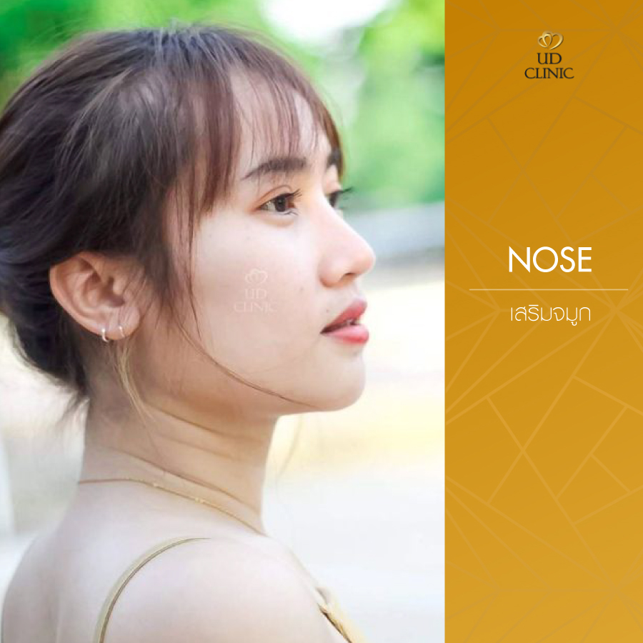 UD-Clinic-Review-Nose-35