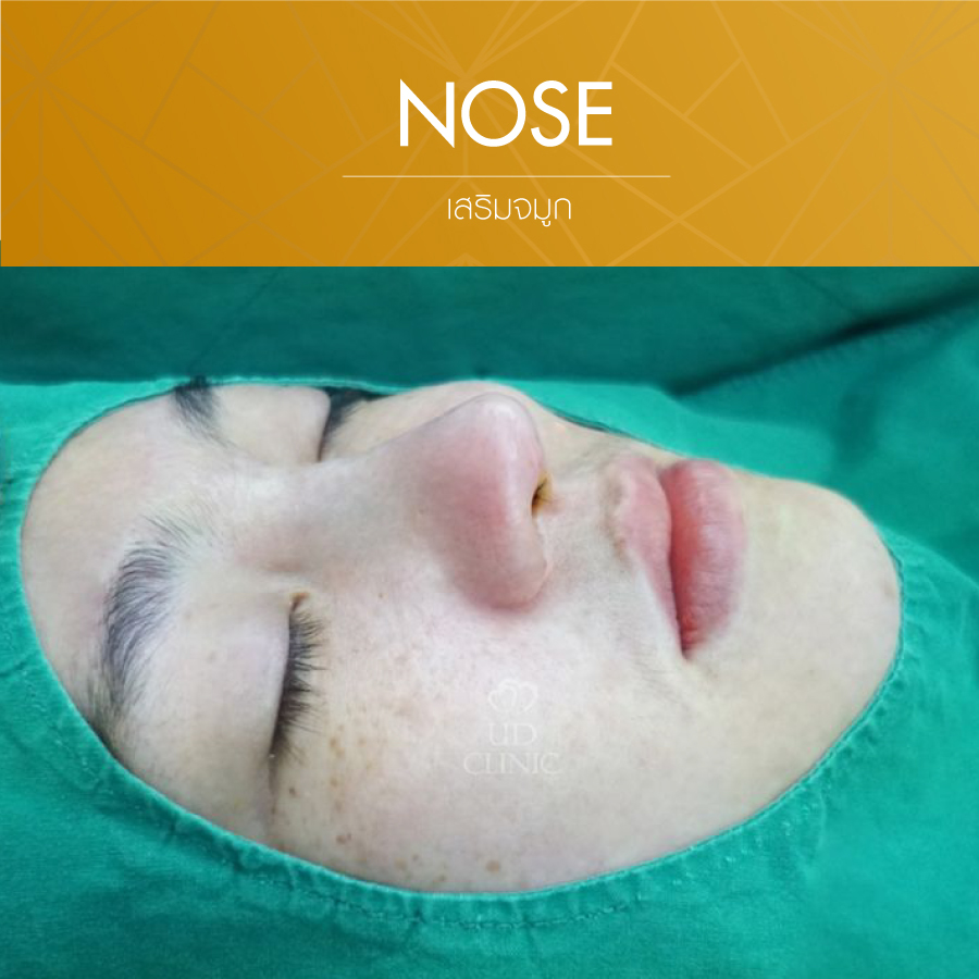 UD-Clinic-Review-Nose-43