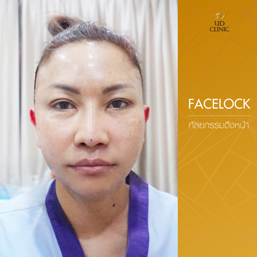 UD-Clinic-Review-facelock-13