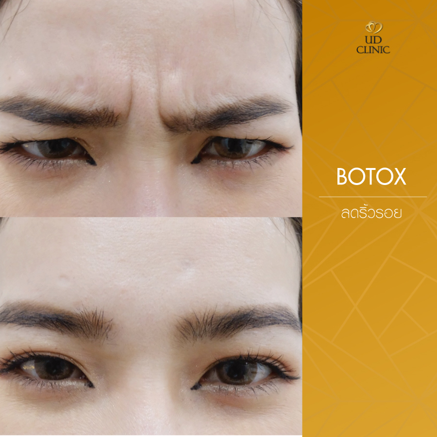 UD-Clinic-Review-Botox-17