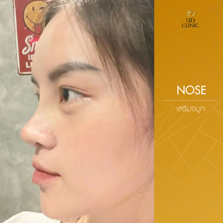 UD-Clinic-Review-Nose-51