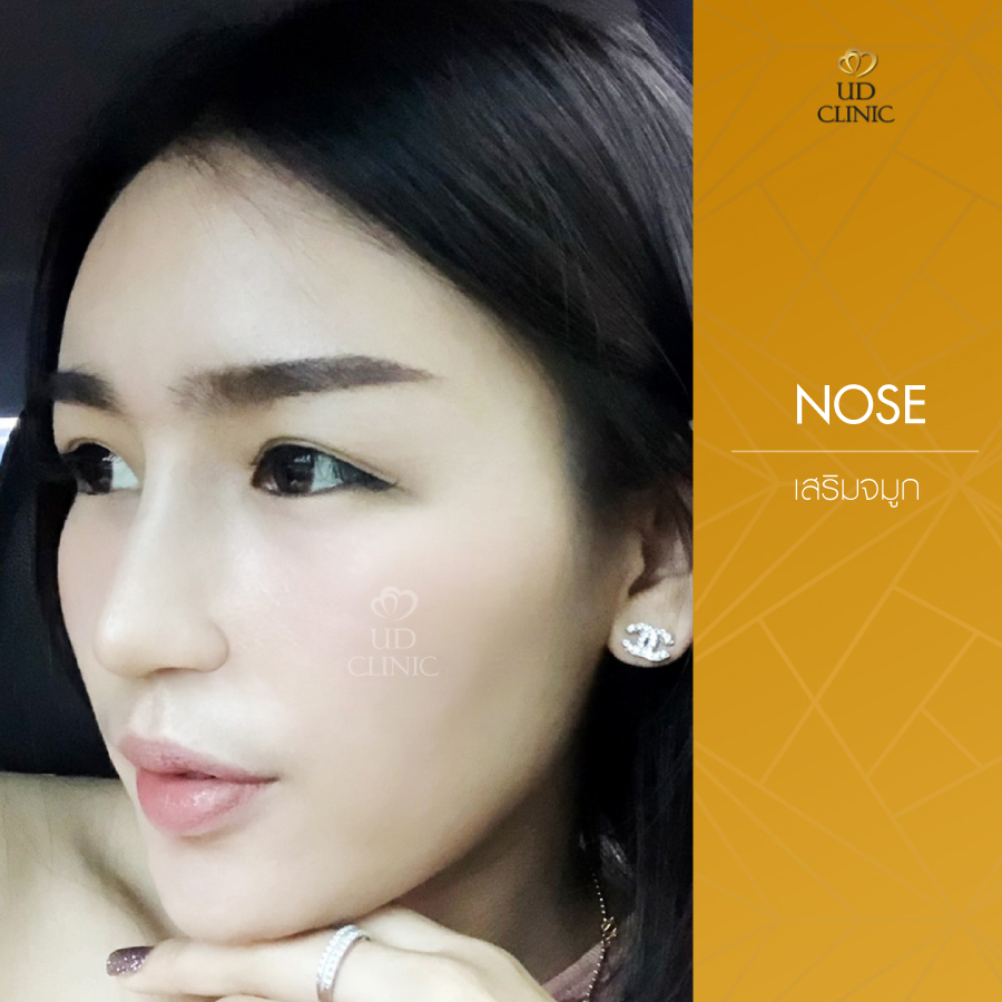 UD-Clinic-Review-Nose-55