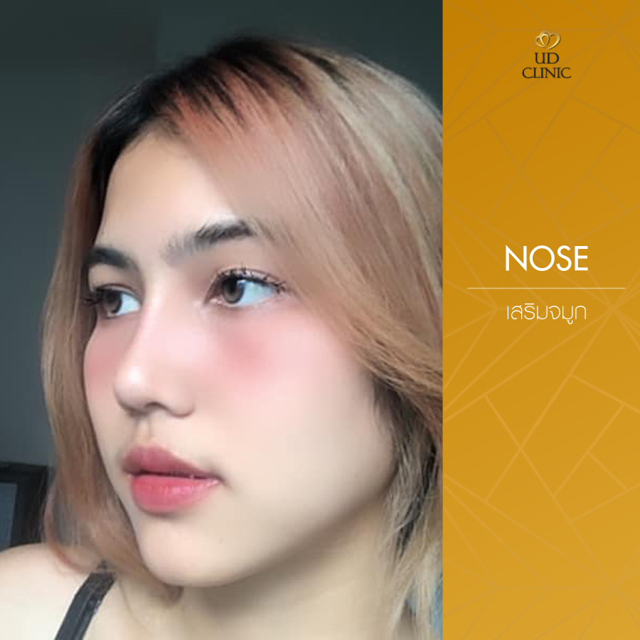 UD-Clinic-Review-Nose-64