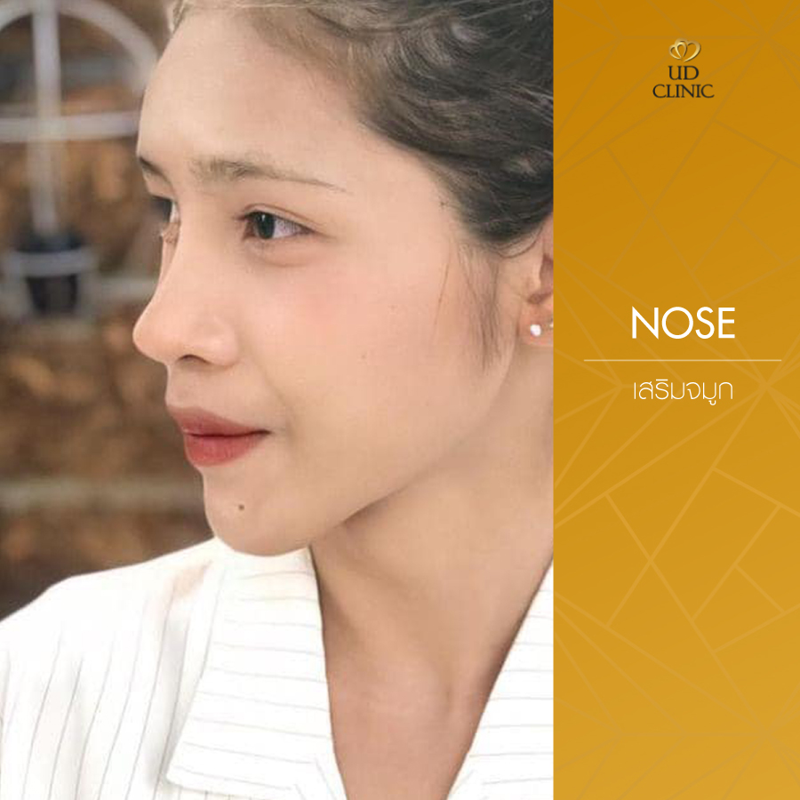 UD-Clinic-Review-Nose-68