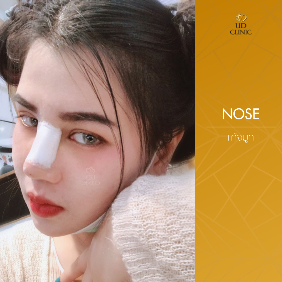 UD-Clinic-Review-Nose-71