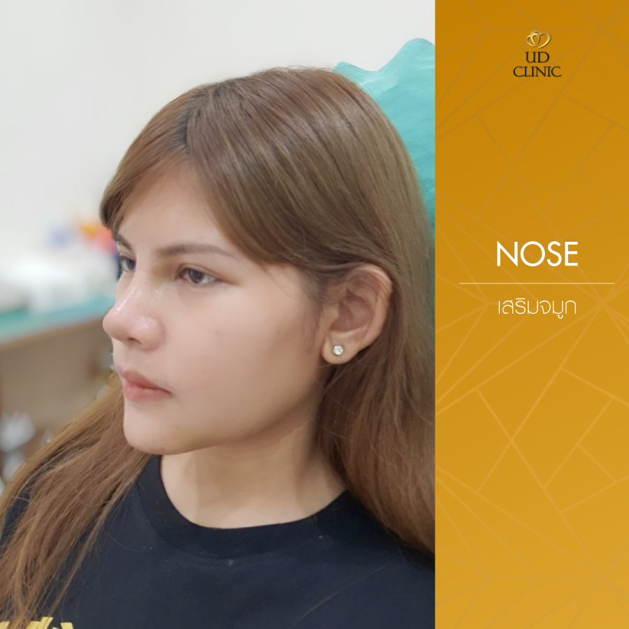 UD-Clinic-Review-Nose-75