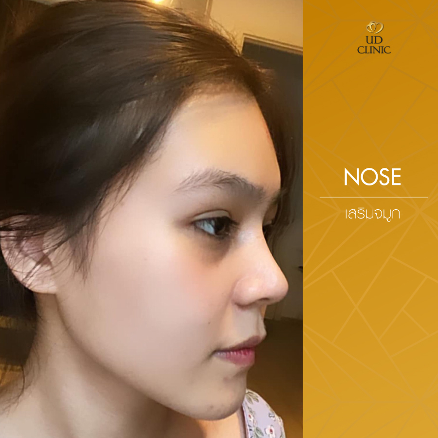 UD-Clinic-Review-Nose-78