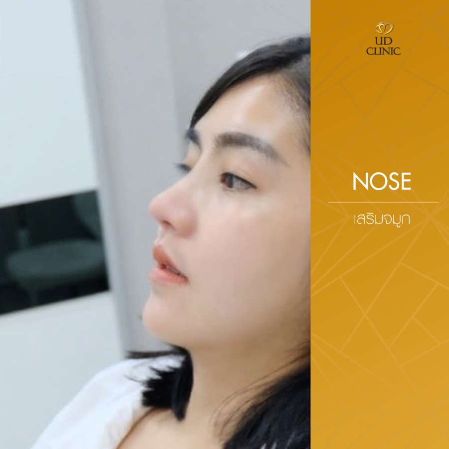 UD-Clinic-Review-Nose-79