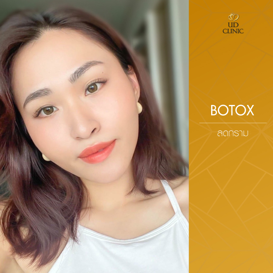 UD-Clinic-Review-Botox-18