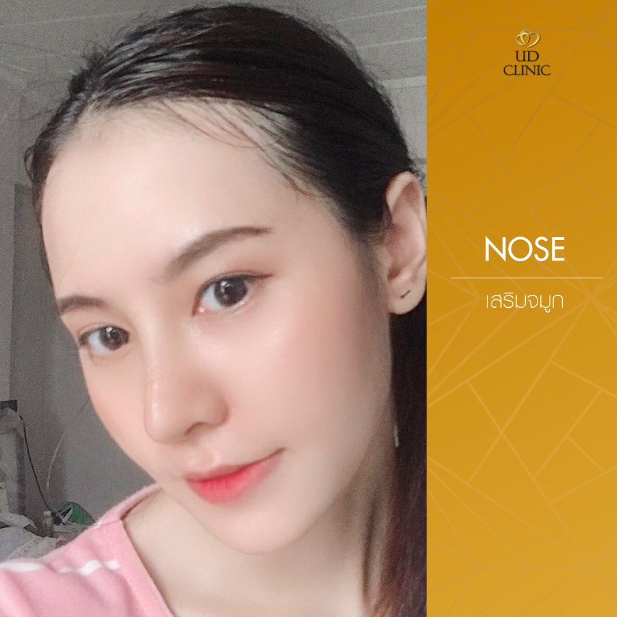 UD-Clinic-Review-Nose-87