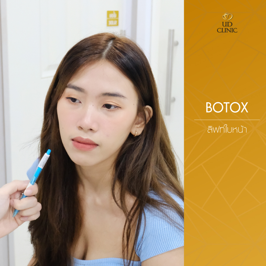 UD-Clinic-Review-Botox-21