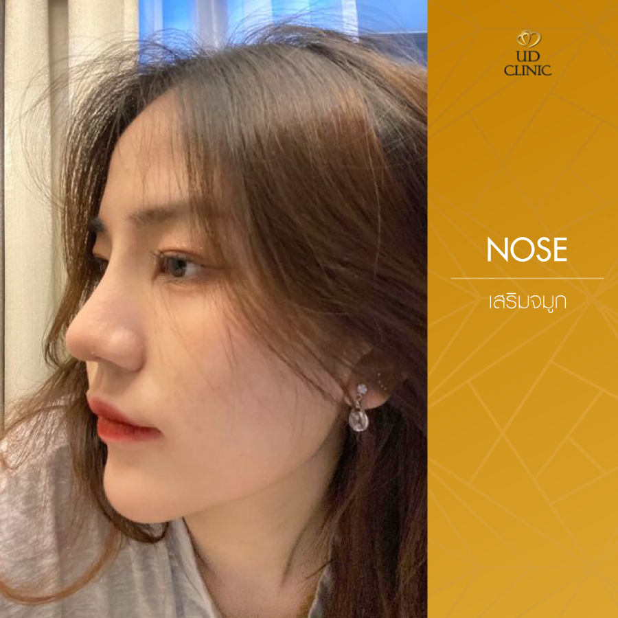 UD-Clinic-Review-Nose-97