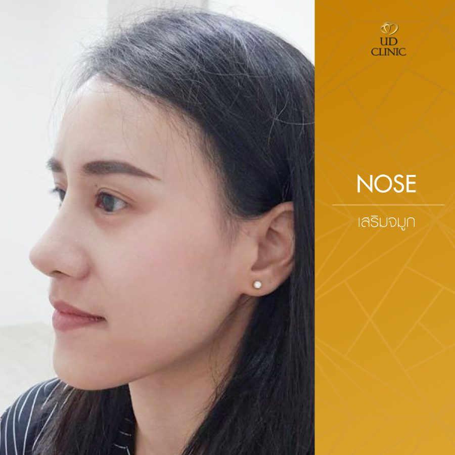 UD-Clinic-Review-Nose-133