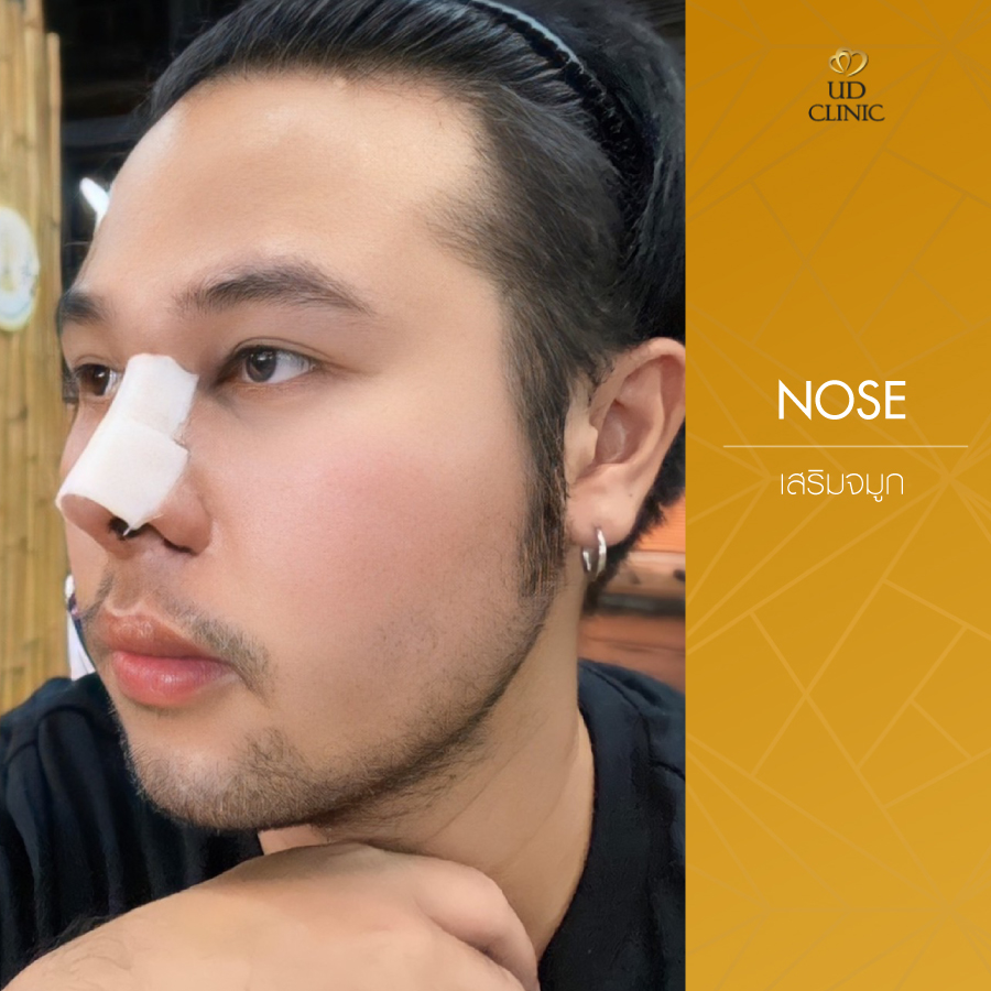 UD-Clinic-Review-Nose-135